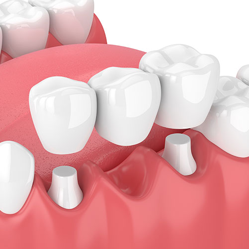 Restorative Dentistry in St Albert